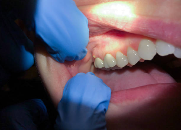 Best Emergency Tooth Extraction in Denton, TX